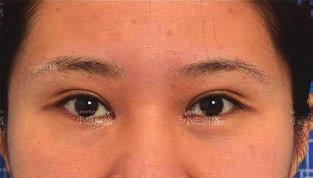 layer, promoting the metabolism and constriction of the expanded fat mass in the eyelids. By Anthony J. Varro, Contributing Editor Dr. Yanli adjusts her protocol to individual patients problems.
