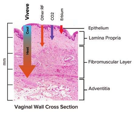 Vaginal laxity and associated tissue damage may adversely impact a woman s sexual health.