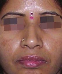 Pigmentation concerns are a growing, global issue; they affect more than 90% of adults over the age of 50.