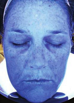 Virtually any facial skin-related indication is well served by HydraFacial, Dr. Arendse emphasized.