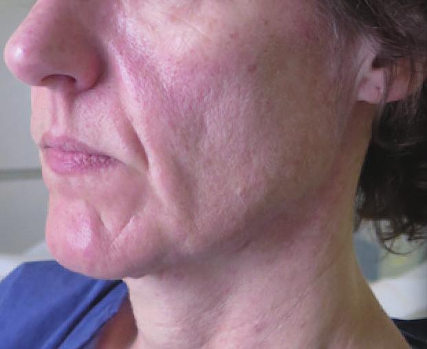 Bellity P et al. Facial rejuvenation enhancing cheek lift Fig. 5. (A, B) Preoperative and 6 