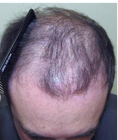 Men can also take Propecia oral medication that slows the progression of hair loss.