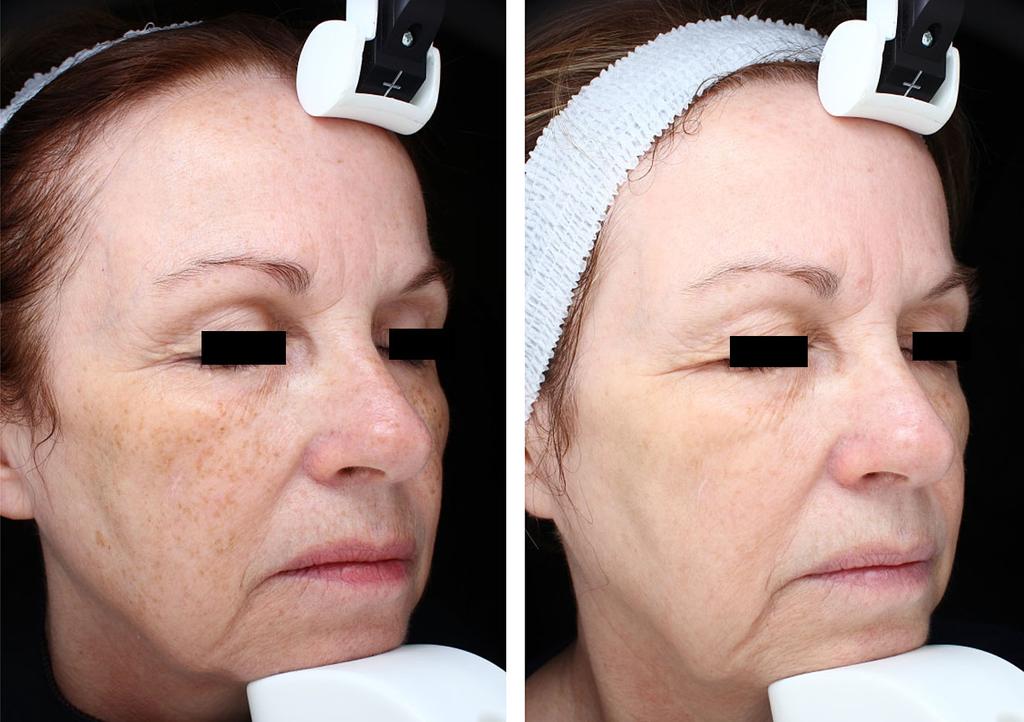 PICOSECOND TREATMENT OF WRINKLES WITH NOVEL LENS 43 Fig. 5. Another clinical result of reduced in fine wrinkles with textural and color improvement.