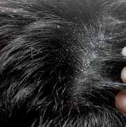Caviar Clinical Dandruf Control WHAT CAUSES DANDRUFF? Dry, itchy and irritated scalp is a common problem and can be caused by a variety of factors.