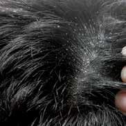 Caviar Clinical Dandruff Control WHAT CAUSES DANDRUFF? Dry, itchy and irritated scalp is a common problem and can be caused by a variety of factors.