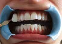 Tooth whitening is a technique that has been in development for over 100 years, and has never been shown to