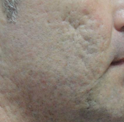 Adult Acne Scars