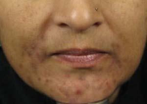 Pigmentation and Acne Scars on Dark Skin Before