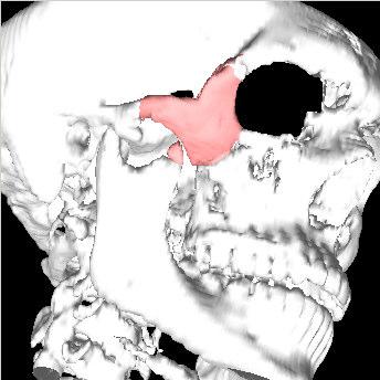 A planning protocol is proposed, divided in four steps: three-dimensional reconstruction from CT imaging, bone fragment segmentation, mirroring of the facial skeleton, and fragment registration. 1.
