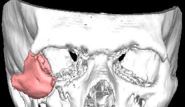Figure 3: initial position of the zygomatic fragment (left) and final planned position after registration to the mirrored target surface (right). facial fractures.