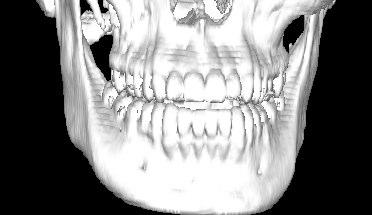 After the mirroring procedure is performed, the distance between the surface of the computed target and the actual zygomatic bone is computed.