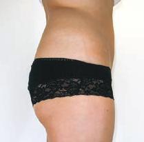 This dual-wavelength, non-invasive laser treatment for fat reduction, body sculpting and skin tightening is a fast, safe and effective non-invasive alternative to laser lipolysis, with no consumables