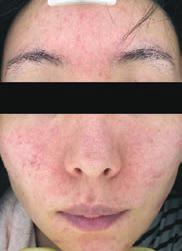 Since the introduction of INTRAcel into the medical aesthetic market in 2008, cosmetic practitioners have had a powerful tool to treat acne, acne scars, various other scars including stretch marks,