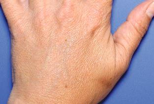 Aging in hands is mainly characterized by atrophy of soft tissues (thin hands with prominent veins and metacarpal bones), loss of skin elasticity (diminished capacity to return to its original state