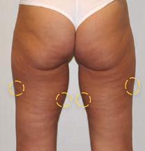 Cellulite patient before and one month after Merz Cellfina treatment Photos courtesy of Melanie Palm, M.D.