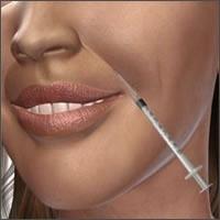 Collagen Injection Procedure Using an ultra fine needle, collagen is injected into the dermis at several points along the edge of the treatment area.