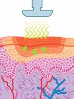 underlying tissues via elastic waves at frequencies as high as 25,000 cycles per second,