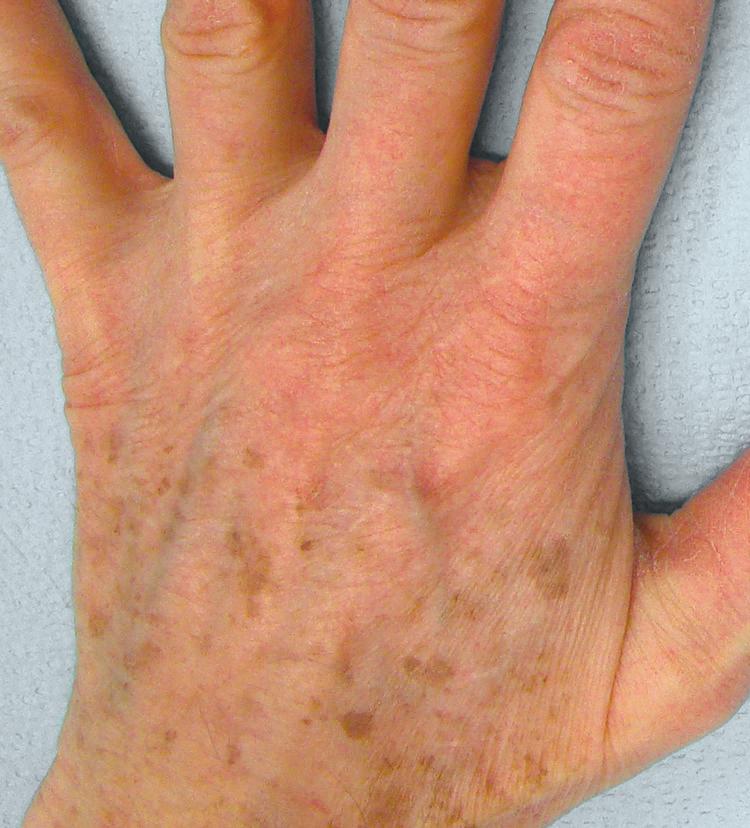 Like facial skin, skin of the hands is typically exposed to UV radiation year-round and is prone to develop signs of photoaging.