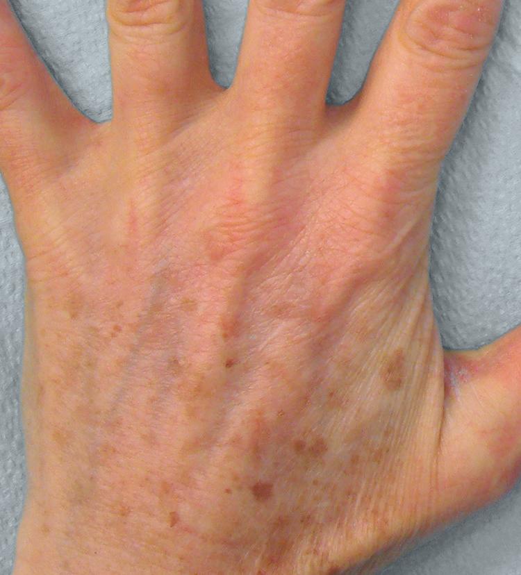 2 Patients and dermatologists are interested in safe, effective, and convenient options to promote a more youthful appearance for the hands.