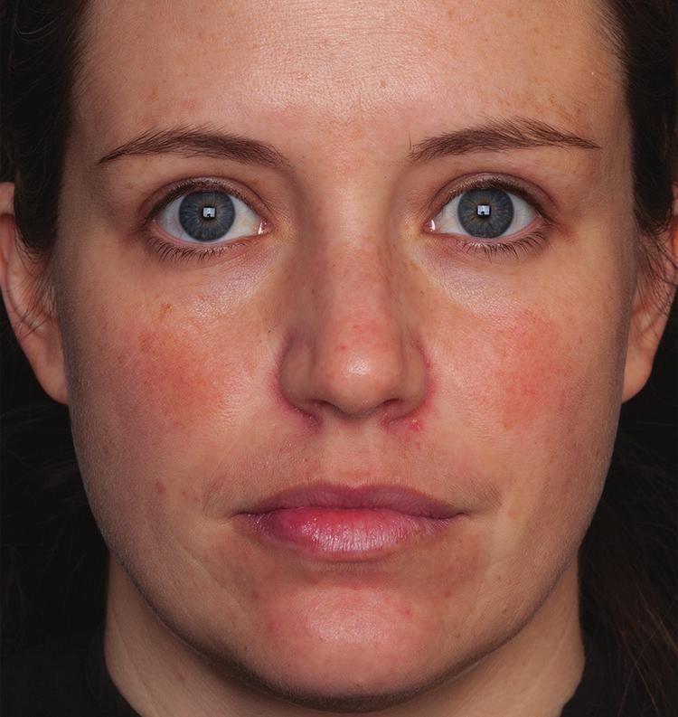Baseline (left) and 15 weeks after Marini Peel System: Transform Peel, Skin Care Management System and Age Intervention Retinol Plus Our results were comparable or superior to what I have seen