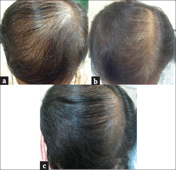 (a, b, c) +2 response noted in patient 3, at the end of six months Figure 8 (a, b, c) Hair regrowth at the end of 1 st month, 3 rd month and at the end of 6 months (+3 response) noted