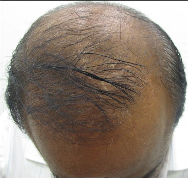 A 30 year old male with Grade V Hamilton Norwood pattern of hair loss with few transplanted hairs seen on frontal area and