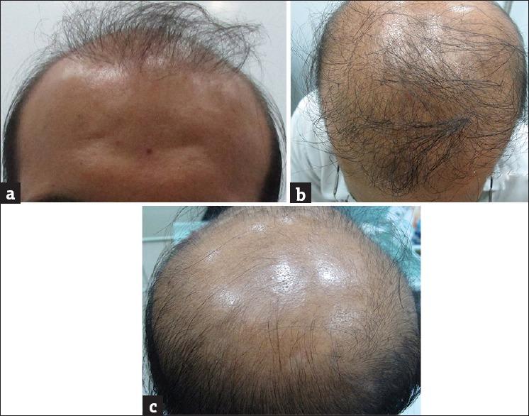 (a, b, c) A 28 year old male with grade VII hair loss with minimal new hair regrowth noted after