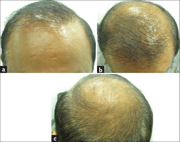 (a, b, c) A 35 year old male with grade V hair loss was on finasteride and minoxidil for