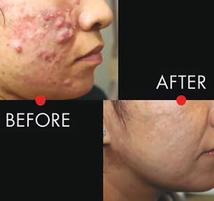 Aerolase laser technology allows immediate results, is uniquely gentle and sanitary, and offers maximum versatility for both adolescent acne and adult acne.
