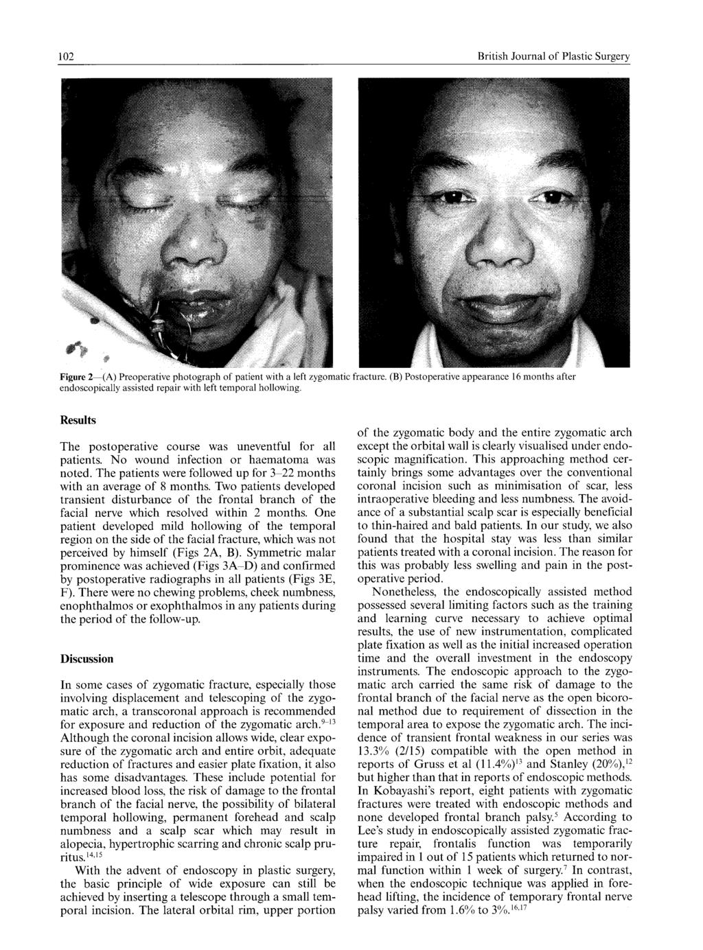 102 British Journal of Plastic Surgery Figure 2 (A) Preoperativephotograph of patient with a left zygomaticfracture.