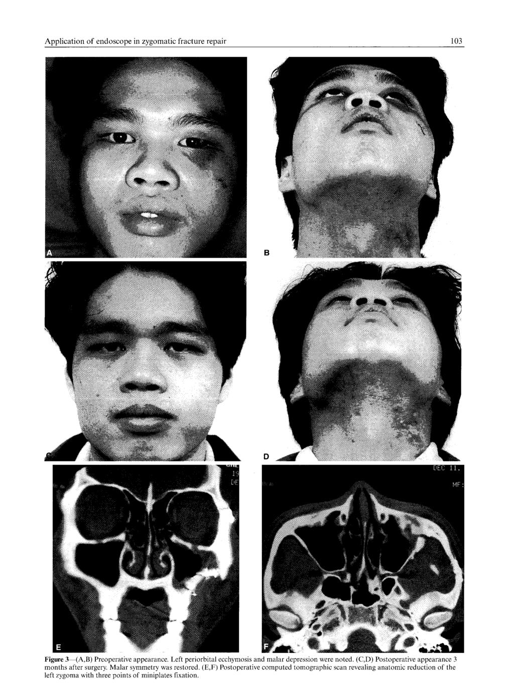 Application of endoscope in zygomatic fracture repair 103 Figure 3 (A,B) Preoperative