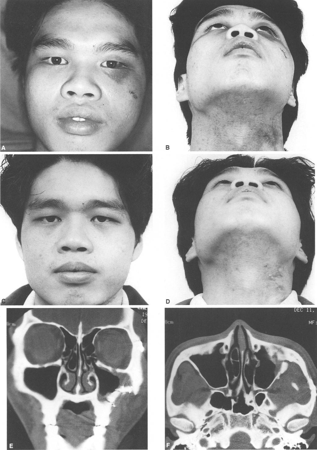 (C,D) Postoperative appearance 3 months after surgery. Malar symmetry was restored.