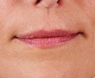 YOUR LIPS Give your lips another reason to smile Whether you ve noticed your lips thinning over time, or simply want fuller lips, JUVÉDERM