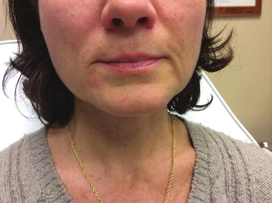 In this photo the patient had some volume loss in the peri-oral area which made her parentheses lines deeply ingrained and created the appearance of mini jowls.