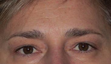 AFTER 3 MONTHLY TREATMENTS: The skin is redensified, plumped and
