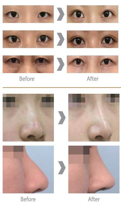 JK WITHME Clinic Plastic Surgery Eye & Nose Surgery for sagging eyelids, droopy eyelids, excessive fat skin from the upper eyelids, eyelid ptosis correction (triangle eyes), etc.
