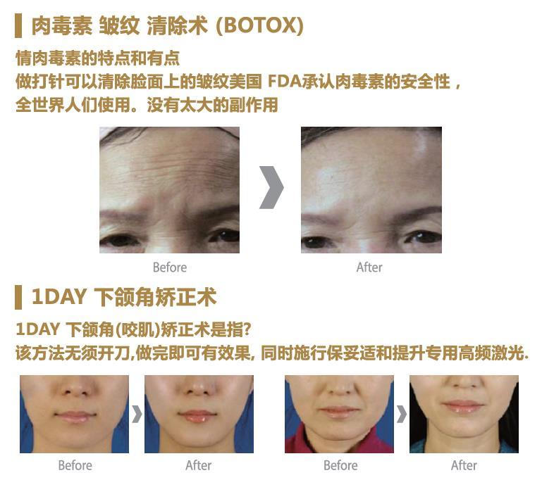 JK WITHME Clinic Botox clinic What is Botox Treatment? Botox blocks the signals from nerves to muscles.