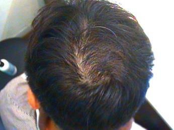 injection, haircell Regaining Healthy and