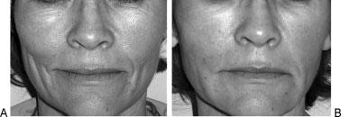 98 FACIAL PLASTIC SURGERY/VOLUME 25, NUMBER 2 2009 Figure 1 A 59-year-old woman: (A) no previous