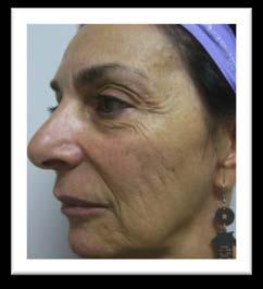 mg/ml) was used to augment the upper and lower lips.