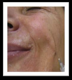 months after application of the Anesthetic Peel- off Mask and