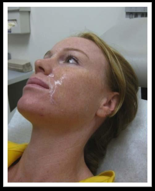 FIGURE 2: The application of the Anesthetic Peel- Off Mask.