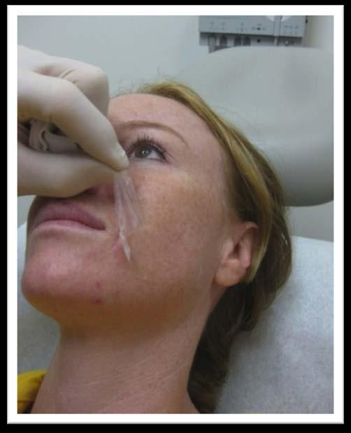 the procedure undertaken. FIGURE 3: The injection sites for facial rejuvenation with the blunt- tip microcannula.