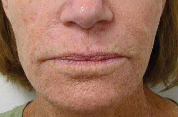 Perioral Aging Marionette lines Down turn angle of mouth Fine radial lines