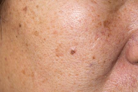 Dermatologic Disorders Warts Rash Hives (Urticaria) Photosensitivity Erythema Photo-damaged
