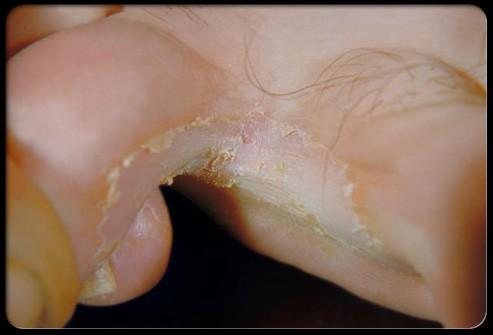 Athlete's foot Athlete's foot is a fungus that causes itching, redness, and cracking. Germs can enter through the cracks in your skin and cause an infection.