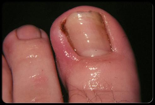 They can also be caused by shoes that are too short. Hammertoes can cause problems with walking and can lead to other foot problems, such as blisters, calluses, and sores.