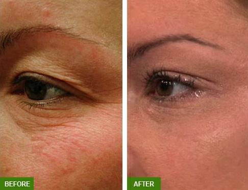 Whether you choose the Full-Face Treatment or the popular Madonna Eyelift, SmartSkin CO2 Laser Rejuvenation is a great way to start the year by losing the years!