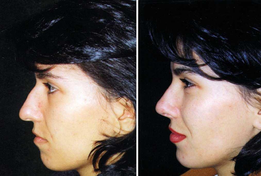 Serdev Sutures in Upper Face: Brow and Temporal Lift; Glabella Muscle Ligation 23 higher position allows repositioning of other soft tissue facial structures, fixed to SMAS.