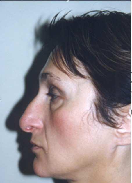 Serdev Sutures in Upper Face: Brow and Temporal Lift; Glabella Muscle Ligation 29 A blunt subgaleal dissection follows till the hairline.